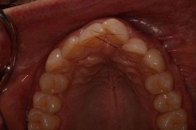Invisalign: Case 17 - Before upper front teeth