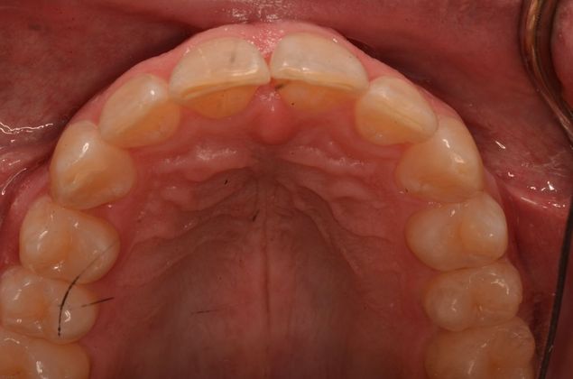 Invisalign: Case 17 - After upper front teeth