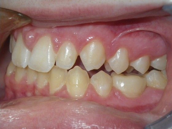 Tooth Colored Crowns for Longterm Primary Teeth without Permanent Replacement Case