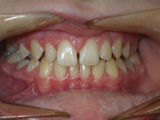 Tooth Colored Crowns for Longterm Primary Teeth without Permanent Replacement: Case 1 - Before