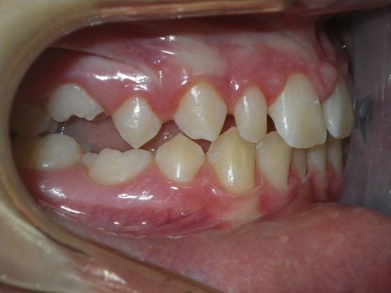 Tooth Colored Crowns for Longterm Primary Teeth without Permanent Replacement: Case 1 - Before