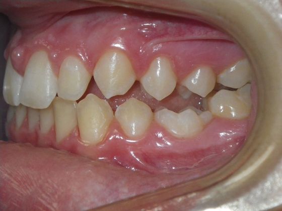 Tooth Colored Crowns for Longterm Primary Teeth without Permanent Replacement: Case 1 - Before