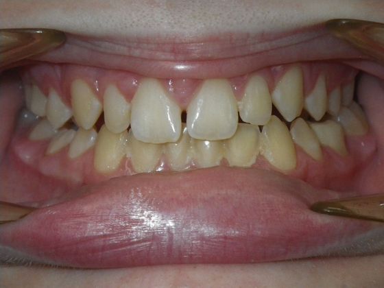 Tooth Colored Crowns for Longterm Primary Teeth without Permanent Replacement: Case 1 - After