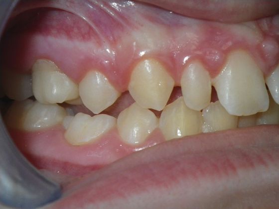Tooth Colored Crowns for Longterm Primary Teeth without Permanent Replacement: Case 1 - After