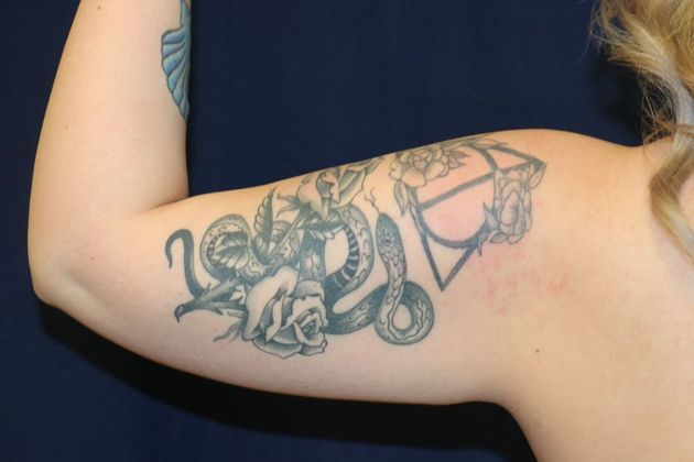 Arm Lift*/Arm Sculpting: Case 12 - Before