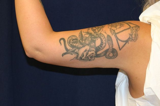Arm Lift*/Arm Sculpting: Case 12 - After