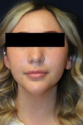 Neck Sculpting : Case 9 - Before