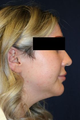 Neck Sculpting : Case 9 - Before