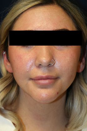 Neck Sculpting : Case 9 - After