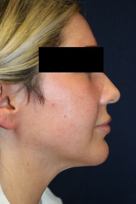 Neck Sculpting : Case 9 - After