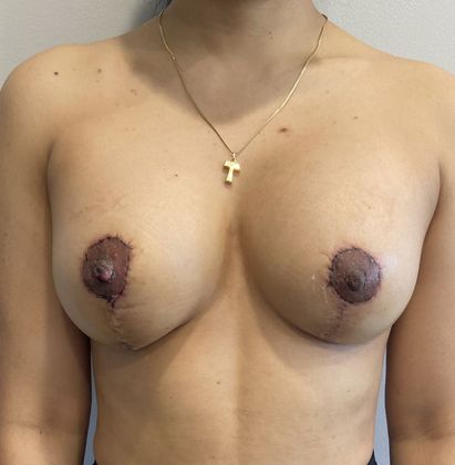 Breast Lift: Case 12 Breast Lift with Implants, Norwalk - After