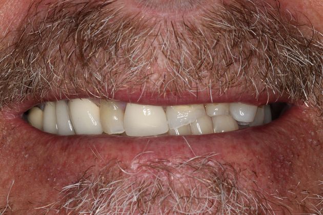 Dental Crowns: Case 29 - Before