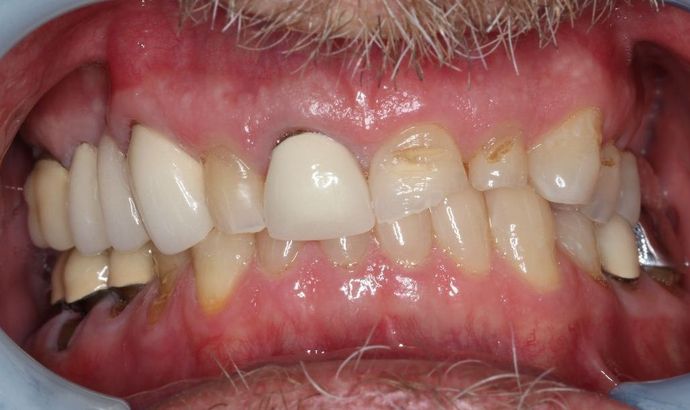 Dental Crowns: Case 29 - Before