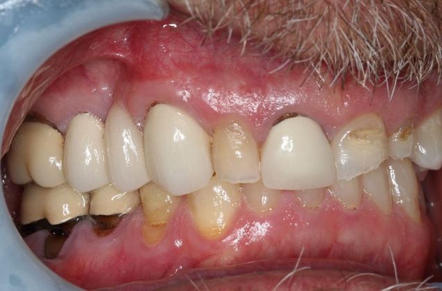 Dental Crowns: Case 29 - Before