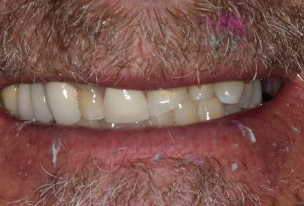 Dental Crowns Case 29 - Before