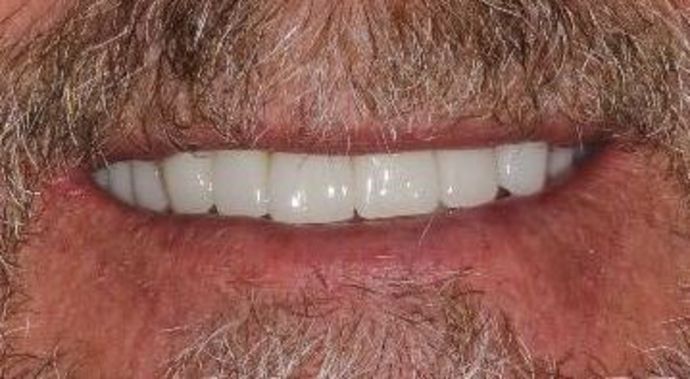 Dental Crowns Case 29 - After