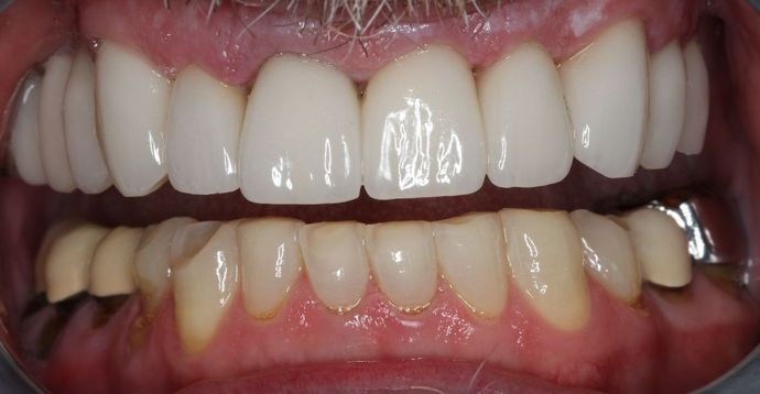 Dental Crowns: Case 29 - After Upper