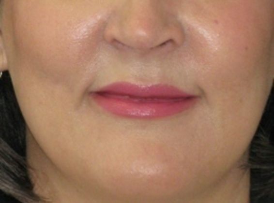 Lip Implants Cases