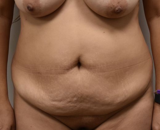 Tummy Tuck (Abdominoplasty): Case 286 - Before
