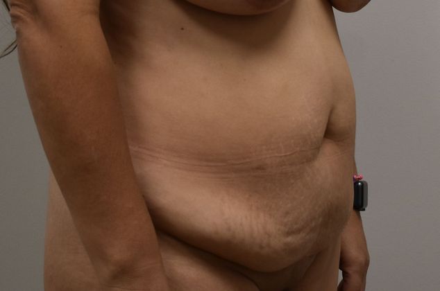 Tummy Tuck (Abdominoplasty): Case 286 - Before
