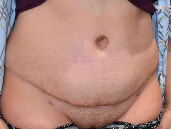 Tummy Tuck (Abdominoplasty): Case 287 - After