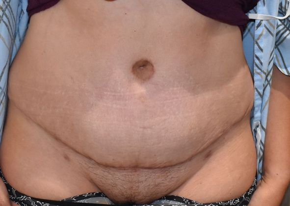 Tummy Tuck (Abdominoplasty): Case 287 - After