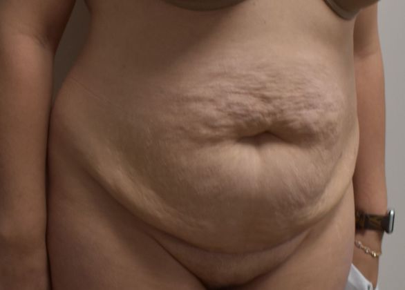 Tummy Tuck (Abdominoplasty): Case 287 - Before