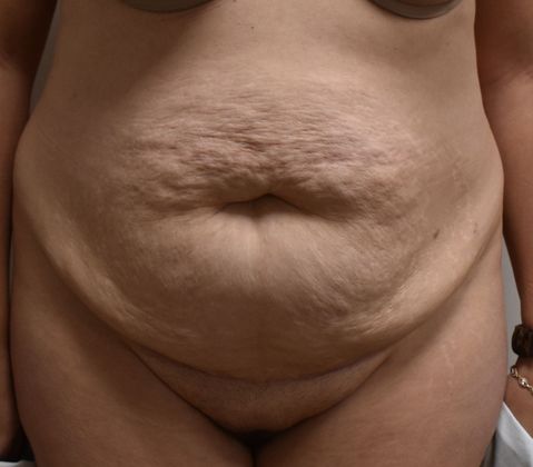 Tummy Tuck (Abdominoplasty): Case 287 - Before