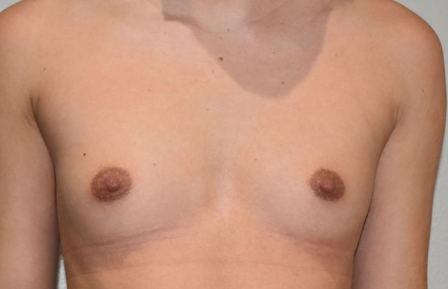 Breast Augmentation Case 638 - Before