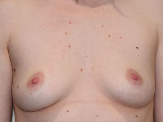 Breast Augmentation Case 639 - Before