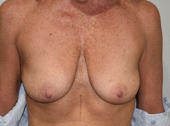 Breast Augmentation w/ Lift: Case 364 - Before