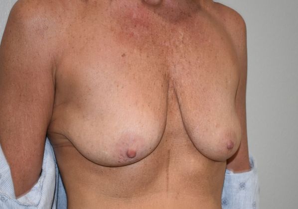 Breast Augmentation w/ Lift: Case 364 - Before