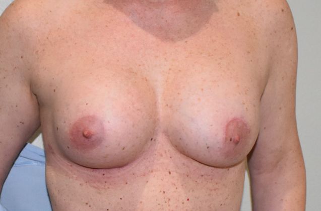 Breast Augmentation Case 641 - After