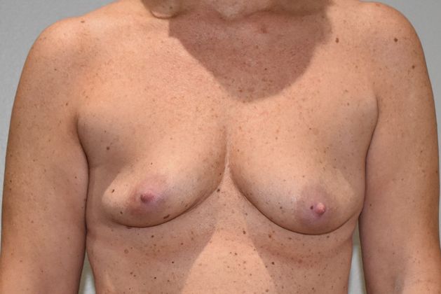 Breast Augmentation Case 641 - Before