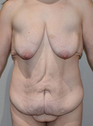 Massive Weight Loss : Case 82 - Before
