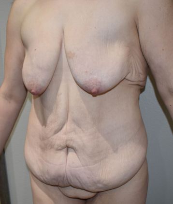 Massive Weight Loss : Case 82 - Before