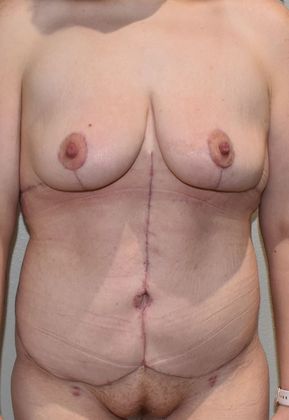 Massive Weight Loss : Case 82 - After