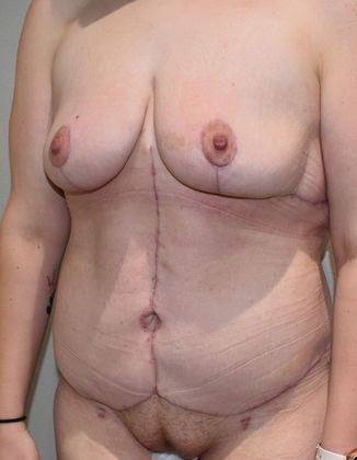 Massive Weight Loss : Case 82 - After