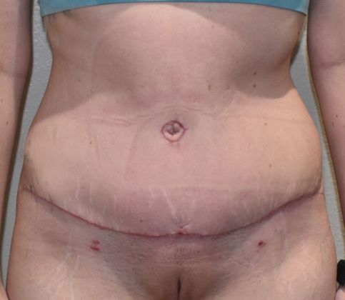 Tummy Tuck (Abdominoplasty): Case 290 - After