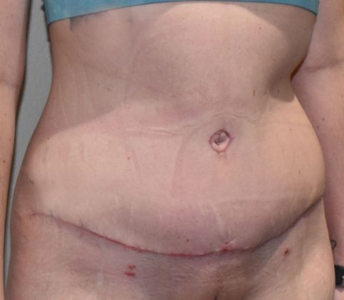 Tummy Tuck (Abdominoplasty): Case 290 - After