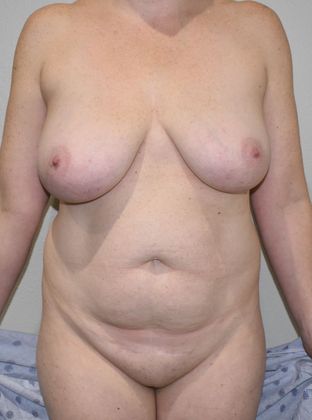 Mommy Makeover Case 191 - Before