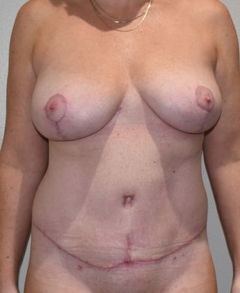 Mommy Makeover Case 191 - After