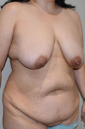 Mommy Makeover: Case 192 - Before