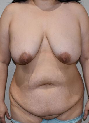 Mommy Makeover Case 192 - Before