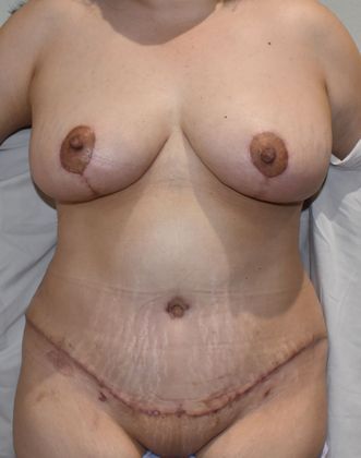 Mommy Makeover Case 192 - After