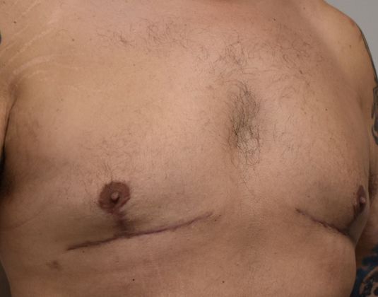 Gynecomastia: Case 3 - After