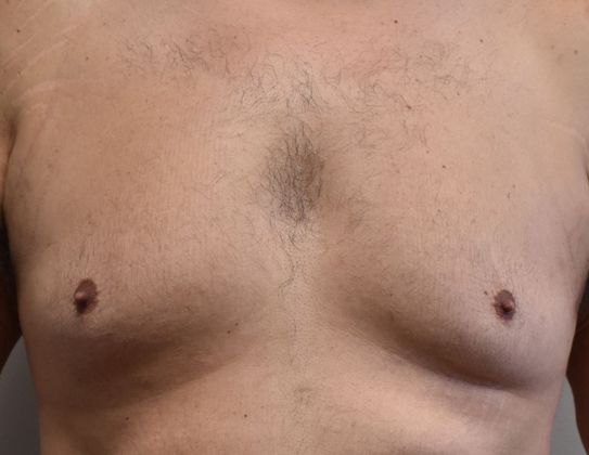 Gynecomastia: Case 3 - Before