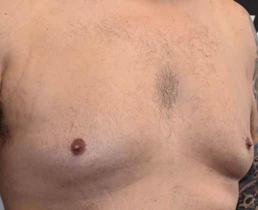 Gynecomastia: Case 3 - Before
