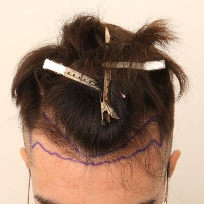 Hair Transplant - Male: Hairline FUE - Case 5 - Before FUE hair transplant