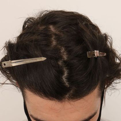 Hair Transplant - Male: Hairline FUE - Case 5 - After FUE hair transplant